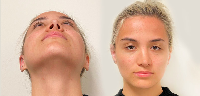 Rinoplastia
