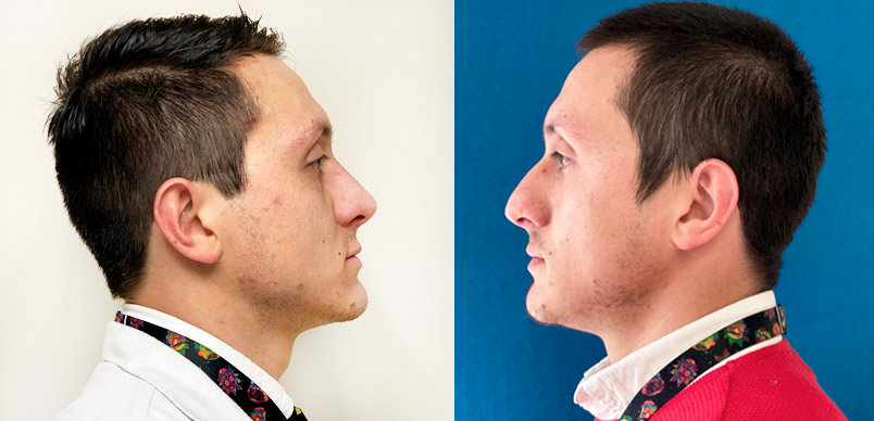 Rinoplastia