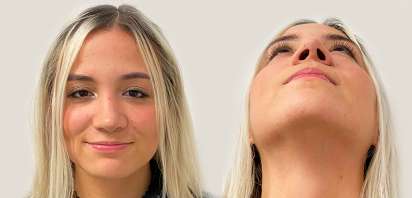 Rinoplastia