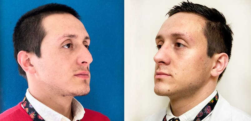 Rinoplastia