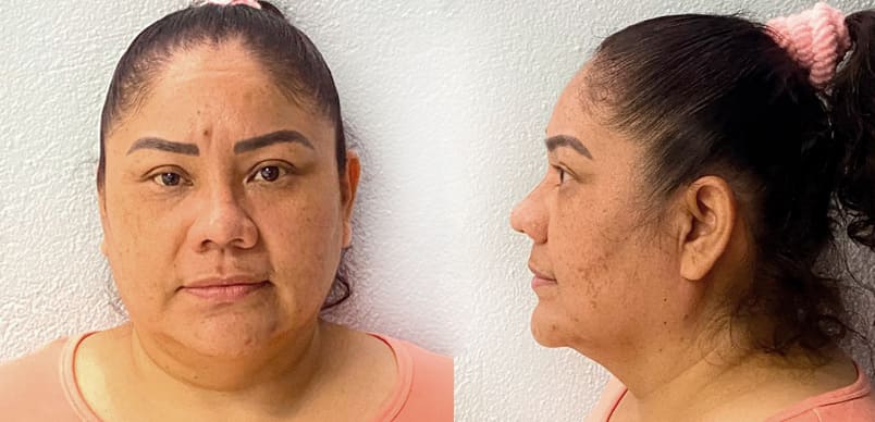 Rinoplastia y liposucción papada y ángulo mandíbula