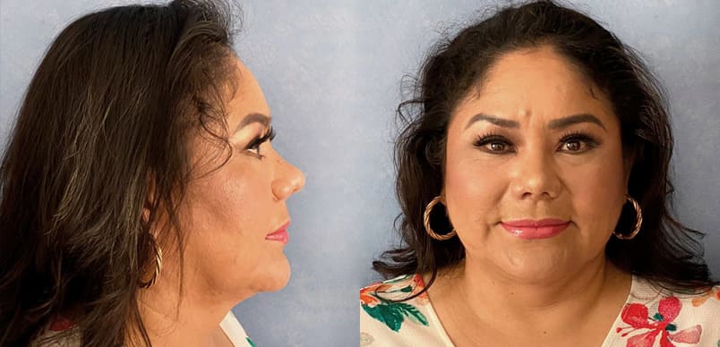 Rinoplastia y liposucción papada y ángulo mandíbula