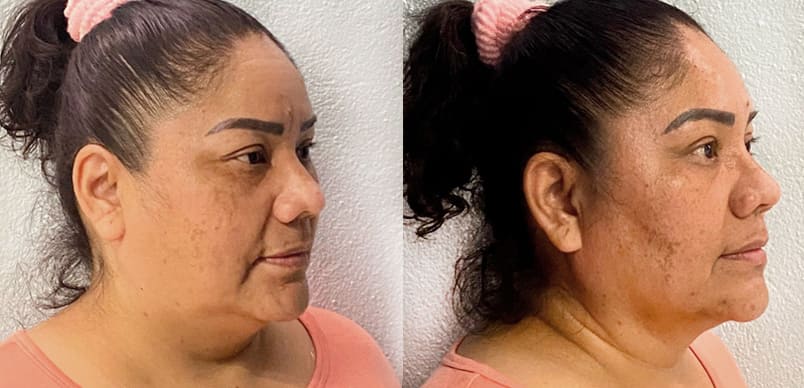 Rinoplastia y liposucción papada y ángulo mandíbula