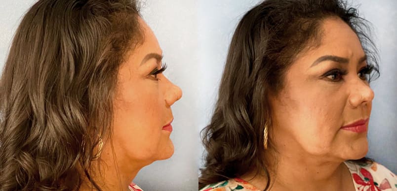 Rinoplastia y liposucción papada y ángulo mandíbula