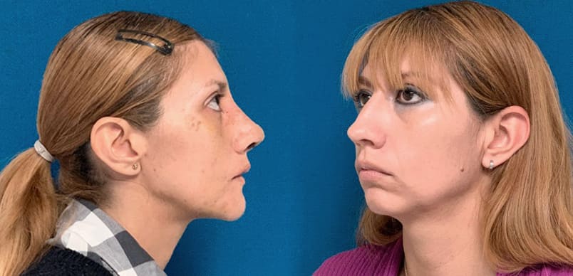 Rinoplastia y mentoplastia