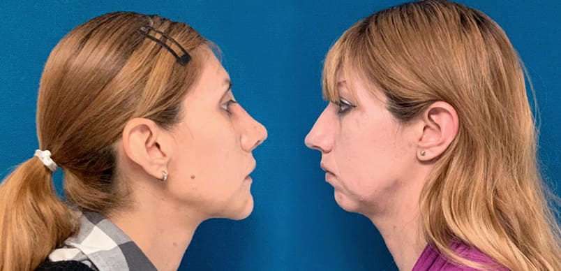 Rinoplastia y mentoplastia